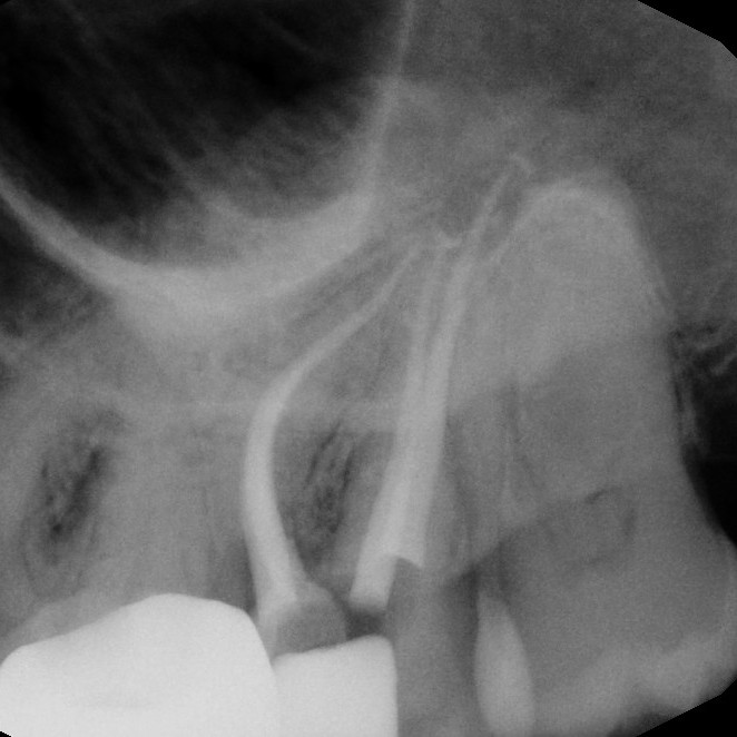 After Endodontic Treatment Case 3 - Harp Endodontics Manhattan New York